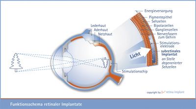 Funktionsweise und Implantationsort des subretinalen Implantates (Alpha IMS) der Retina Implant AG, Copyright: Retina Implant AG Abbildung eines retinalen Funktionsschemas