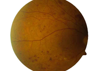 Diabetische Retinopathie, Copyright: Dr. Erdem Ergun Bild eines Auges mit diabetischer Retinopathie