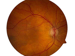 Diabetisches Makulaödem, Copyright: Dr. Erdem Ergun Bild eines Auges mit diabetischem Makulaödem