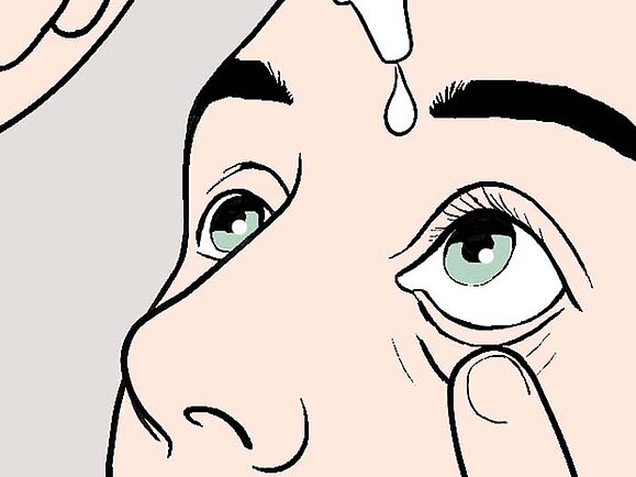 Illustration einer Person, die sich das untere Augenlid mit einer Hand hinunterzieht und mit der anderen Augentropfen eintropt, während sie nach oben blickt.