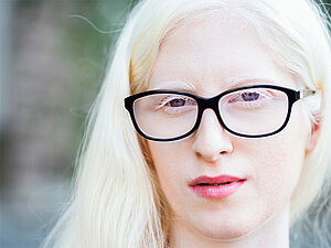 Am 13. Juni ist Internationaler Tag der Aufklärung über Albinismus Close-Up von Frau mit sehr hellen Haaren und Haut, die eine Brille trägt.