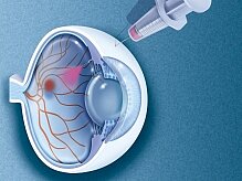 Die intravitreale Injektion: eine viel versprechende Behandlung Schematische Darstellung einer Injektion ins Auge